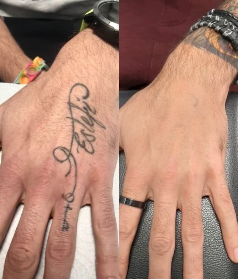 Eliminación de tatuajes en Tattoo Killer