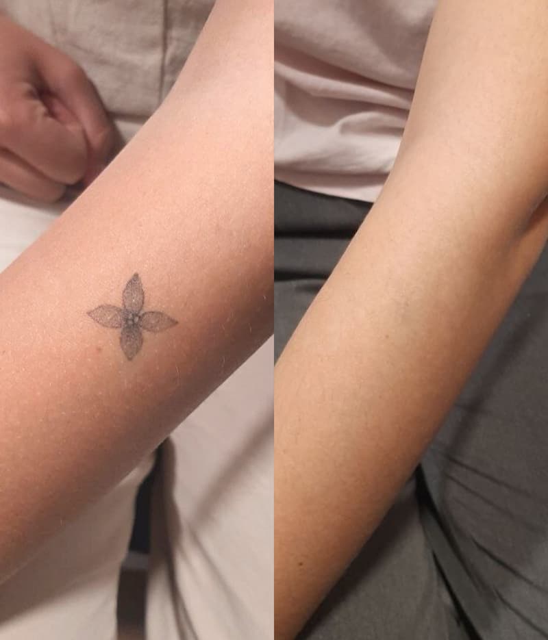 Eliminación de tatuajes en Tattoo Killer