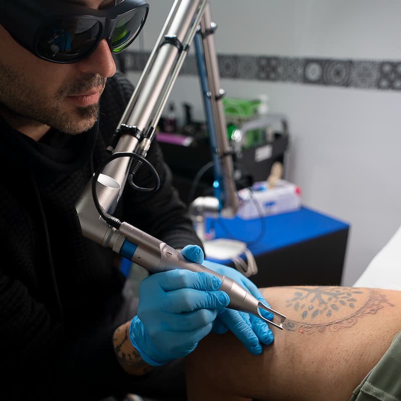 Eliminación de tatuajes