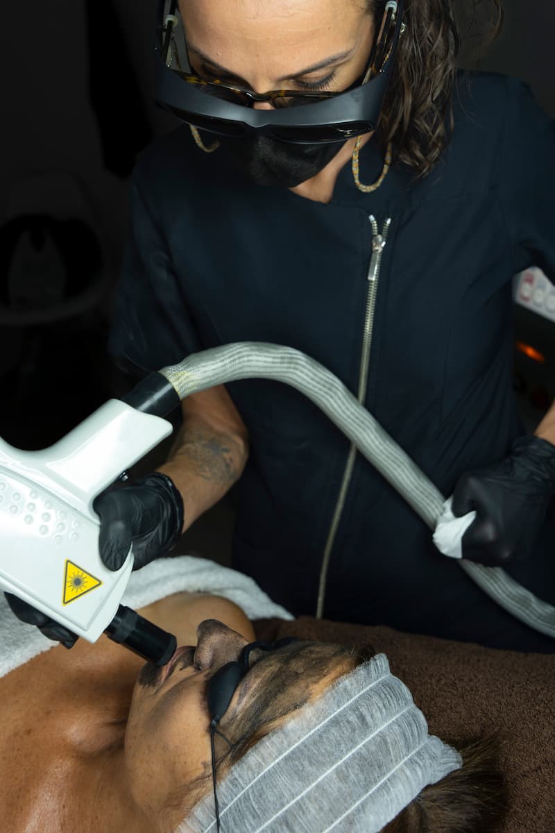 Peeling con carbon activo