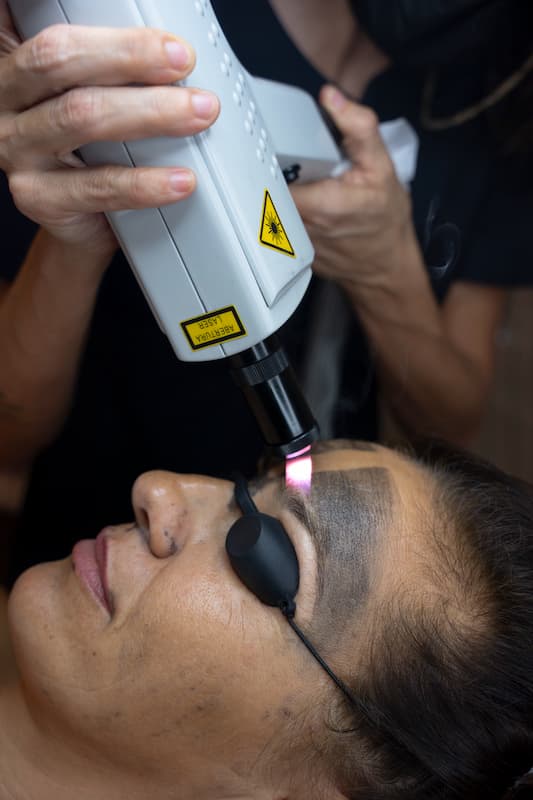 Peeling con carbon activo y laser