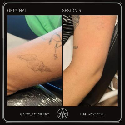 Proceso completo de la eliminación de un tattoo en el brazo⚡️🐚 

Empezamos a borrarlo en 2022 junto a otros tatuajes de la zona. Este en concreto tenía entre 4 y 6 años y no había sido repasado, así que pudimos eliminar toda la tinta en solo 5 sesiones 💥

El número de sesiones necesarias para borrar un tattoo depende de varios factores como su antigüedad, profundidad, zona del cuerpo… 

Mándame un mensaje si quieres asesoramiento gratuito sobre tu caso 📨

#aitortattookiller #tattookiller #antesydespuestattoo #eliminartatuajes #eliminaciondetatuajes #lasertattooremovalspecialist #lasertattooremovalbeforeandafter #tattooremover #lasertattooremoval #eliminartatuajesbarcelona #eliminaciontatuajesbarcelona