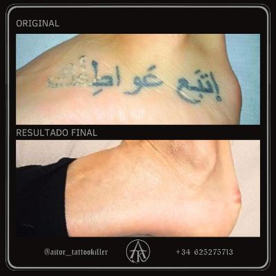 Eliminación tatuajes eliminar tattoos tattoo Barcelona Girona Lleida Tarragona