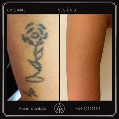 Eliminación de un tatuaje hecho con hollín ⚡️

👉🏼 El tattoo fue realizado mediante una técnica distinta a la habitual: quemar la parte inferior de una lata y utilizar las cenizas como tinta. 

🚩 Esta práctica no es recomendable ya que no garantiza las condiciones mínimas de higiene y es perjudicial para la salud.

Su resultado no es el mismo que el del método común, pero se elimina mucho más rápido. Así que solo bastaron 3 sesiones para eliminar por completo cualquier rastro del tatuaje de la imagen 💥

¿Qué te parece? ¿Conocías esta técnica? 👀

#aitortattookiller #tattookiller #tattooremover #tattooremove #tattooremovalbeforeandafter #lasertattooremoval #tattooremovalspecialists #eliminaciontatuajes #eliminartatuajes #lasertattooremovalspecialist #antesydespués #borrartatuajes #borradodetatuajes