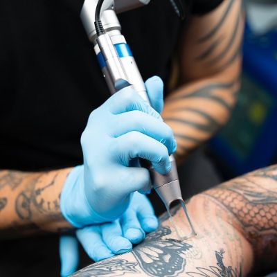 Eliminación tatuajes eliminar borrar tattoo Barcelona Tarragona Lleida Girona