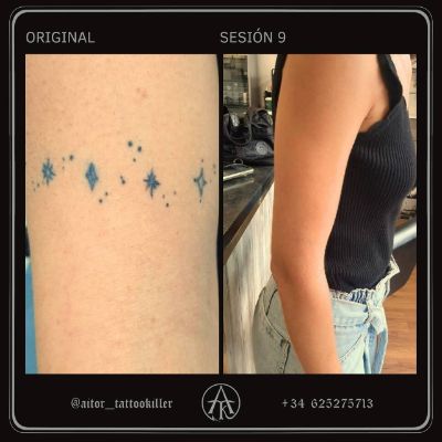 Proceso de eliminación de un tatuaje en la zona del brazo 💥

👉🏼 Como veis, el número de sesiones necesarias para borrar un tattoo no es proporcional a su tamaño. Hay otros factores que influyen: cómo esté inyectado el pigmento, su antigüedad, la zona del cuerpo donde se ubique…

No obstante, con tiempo y paciencia, conseguimos eliminar al 100% cualquier tipo de tinta sin dañar la piel ⚡️

¿Qué te parece este trabajo? Os leo en comentarios 👀

#aitortattookiller #tattooremover #tattooremovalbeforeandafter #tattooremovallaser #tattooremove #removetattoo #eliminaciondetatuajes #eliminartatuajes #borrartatuajes #lasertattooremoval
